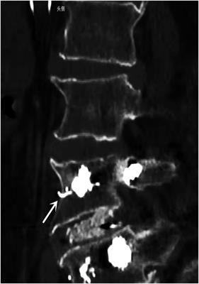 Case report: Cement entrapped in the inferior vena cava filter after pedicle screw augmentation